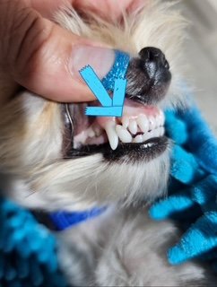 Baby tooth removal