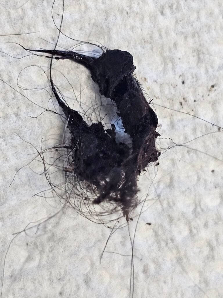 Ear infection caused by build up of hair in the ear canal
