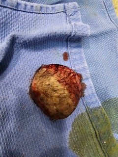 Tumor removal before,  and the physical mass.