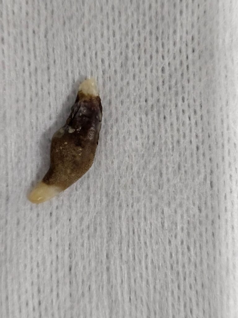 Rotten tooth eating at skull bone