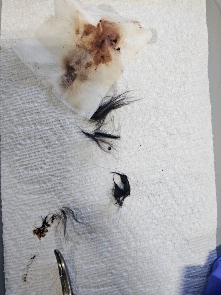 Ear infection caused by build up of hair in the ear canal